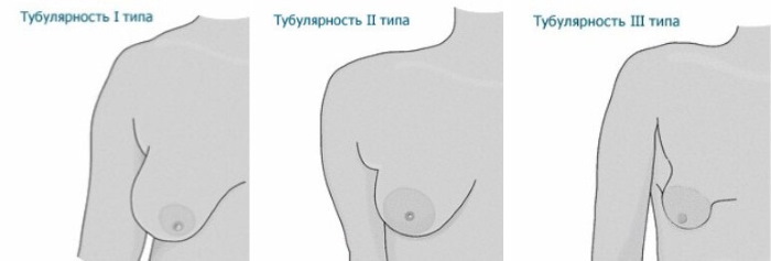 Цевасти облик млечних жлезда, дојке. Фотографија, корекција без операције за жене, мушкарце