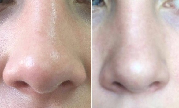 Thu gọn cánh mũi bằng thuốc mỡ. Ảnh trước và sau, giá cả, đánh giá, hậu quả