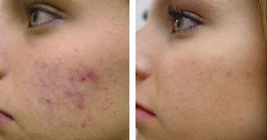 Limpando o rosto de uma adolescente por uma esteticista. Preço, comentários