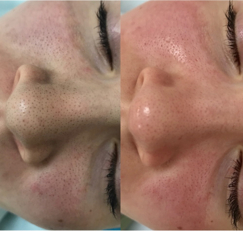 Limpando o rosto de uma adolescente por uma esteticista. Preço, comentários