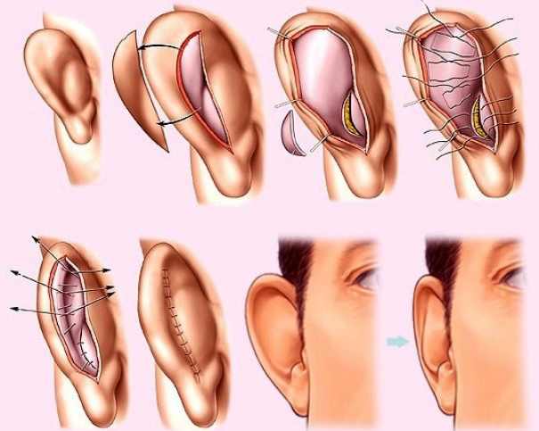 การผ่าตัดหูสำหรับอาการหูตึง ราคาเท่าไหร่