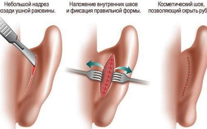การผ่าตัดหูสำหรับอาการหูตึง ราคาเท่าไหร่
