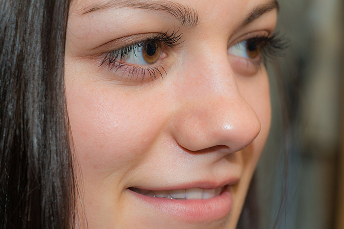 Gadis mempunyai hidung yang lebar. Apa yang perlu dilakukan, bagaimana menyingkirkan, rhinoplasty