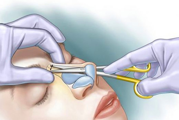 Gadis mempunyai hidung yang lebar. Apa yang perlu dilakukan, bagaimana menyingkirkan, rhinoplasty