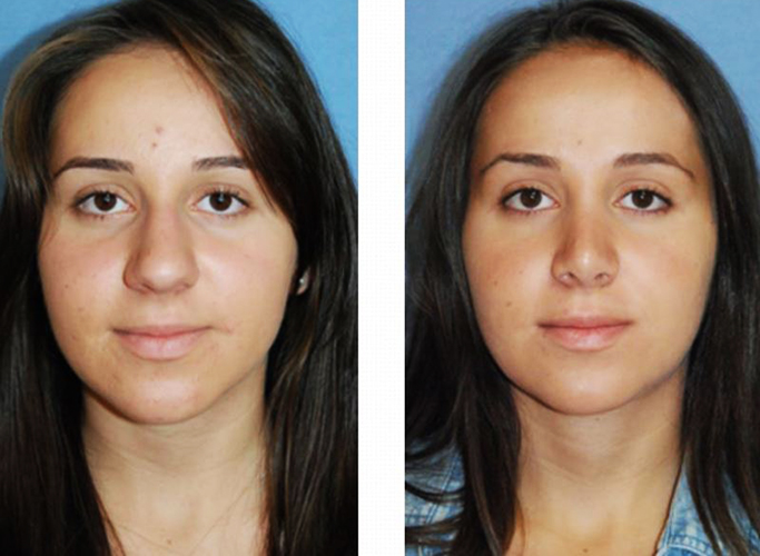 Gadis mempunyai hidung yang lebar. Apa yang perlu dilakukan, bagaimana menyingkirkan, rhinoplasty