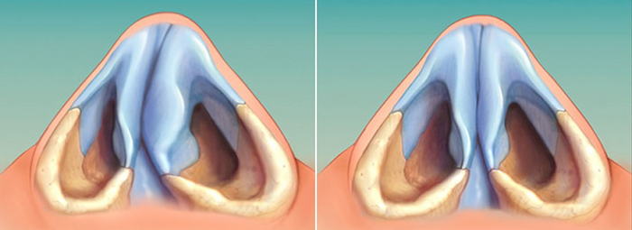 Gadis mempunyai hidung yang lebar. Apa yang perlu dilakukan, bagaimana menyingkirkan, rhinoplasty
