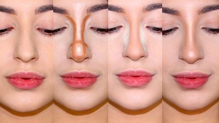Gadis mempunyai hidung yang lebar. Apa yang perlu dilakukan, bagaimana menyingkirkan, rhinoplasty
