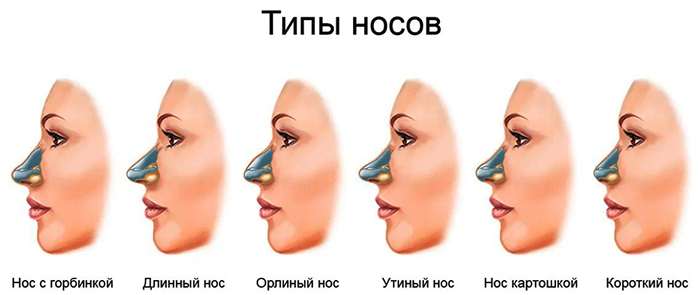 Gadis mempunyai hidung yang lebar. Apa yang perlu dilakukan, bagaimana menyingkirkan, rhinoplasty