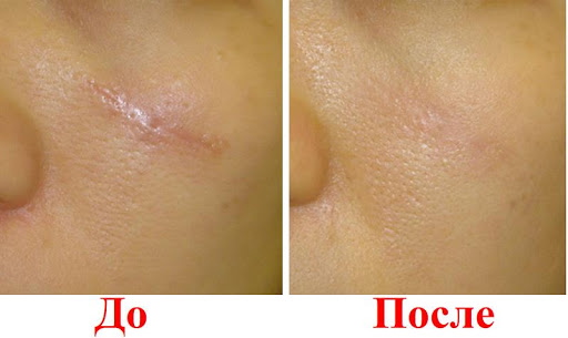 Xóa sẹo bằng laser trên mặt. Đánh giá, ảnh trước và sau, giá cả
