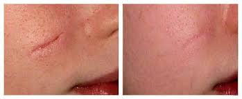 Xóa sẹo bằng laser trên mặt. Đánh giá, ảnh trước và sau, giá cả