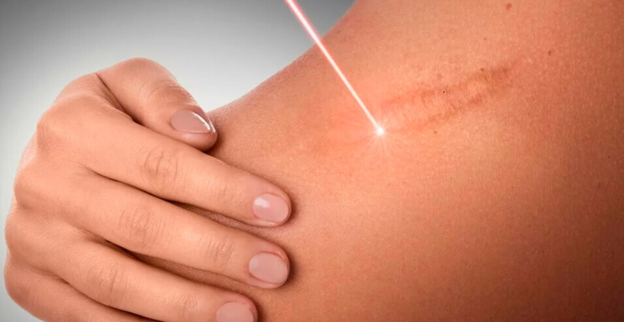 Xóa sẹo bằng laser trên mặt. Đánh giá, ảnh trước và sau, giá cả