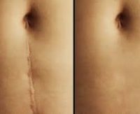 Xóa sẹo bằng laser trên mặt. Đánh giá, ảnh trước và sau, giá cả