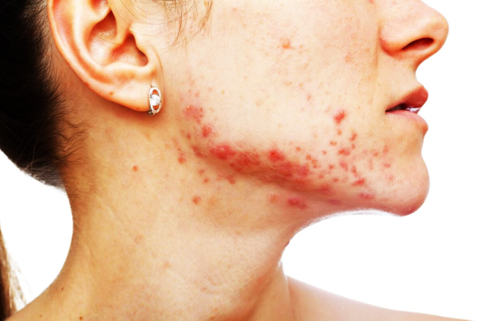 Xóa sẹo bằng laser trên mặt. Đánh giá, ảnh trước và sau, giá cả