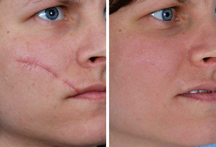 Xóa sẹo bằng laser trên mặt. Đánh giá, ảnh trước và sau, giá cả
