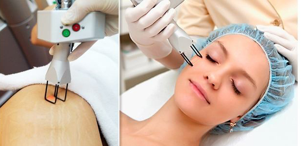 Xóa sẹo bằng laser trên mặt. Đánh giá, ảnh trước và sau, giá cả