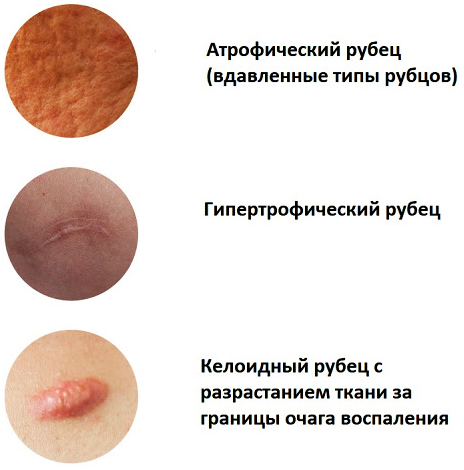Xóa sẹo bằng laser trên mặt. Đánh giá, ảnh trước và sau, giá cả