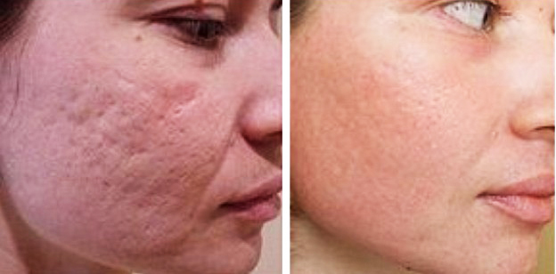 Xóa sẹo bằng laser trên mặt. Đánh giá, ảnh trước và sau, giá cả