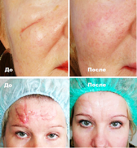 Xóa sẹo bằng laser trên mặt. Đánh giá, ảnh trước và sau, giá cả