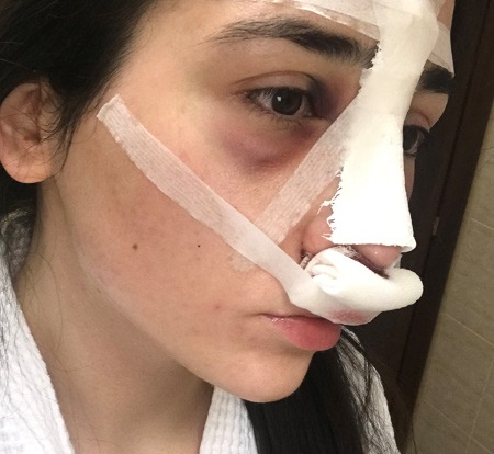 สาวมีจมูกใหญ่ ภาพถ่ายก่อนและหลังการผ่าตัดเสริมจมูก