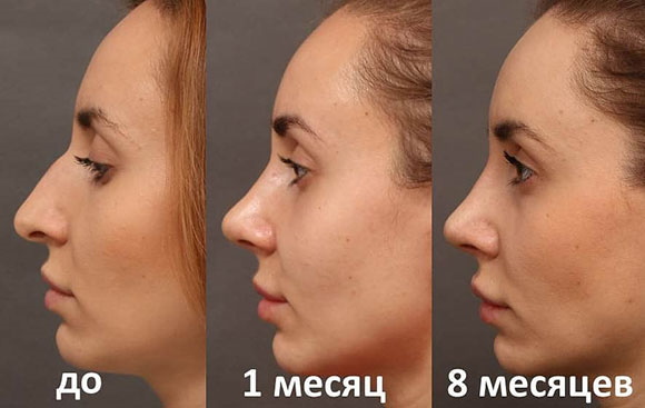 หญิงสาวมีจมูกยาว ภาพถ่ายก่อนและหลังการผ่าตัดเสริมจมูก