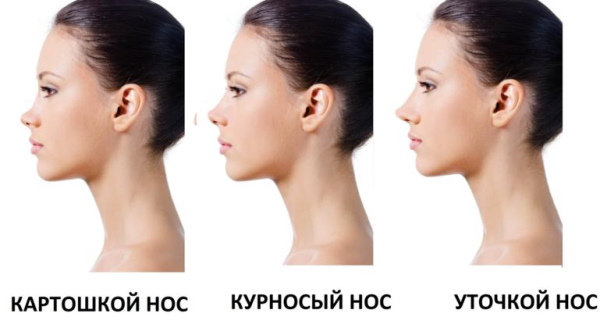 Gadis itu mempunyai hidung sumbing. Cara membetulkan sebelum dan selepas gambar rhinoplasty
