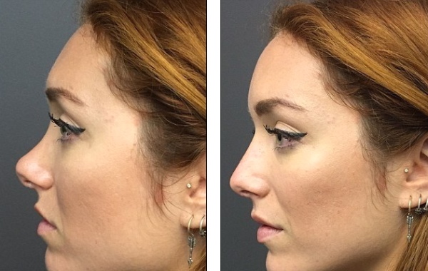 Gadis itu mempunyai hidung sumbing. Cara membetulkan sebelum dan selepas gambar rhinoplasty