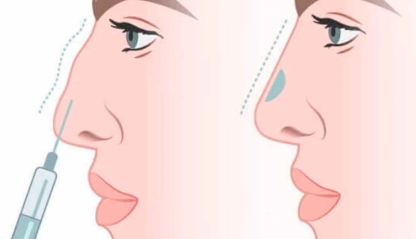 Gadis itu mempunyai hidung sumbing. Cara membetulkan sebelum dan selepas gambar rhinoplasty