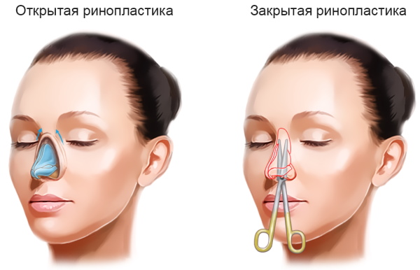 Gadis itu mempunyai hidung sumbing. Cara membetulkan sebelum dan selepas gambar rhinoplasty