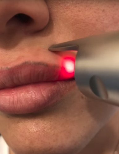 Penyingkiran laser dari solek kekal (tatu) alis, bibir, kelopak mata