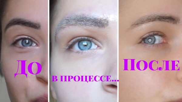 Penyingkiran laser dari solek kekal (tatu) alis, bibir, kelopak mata