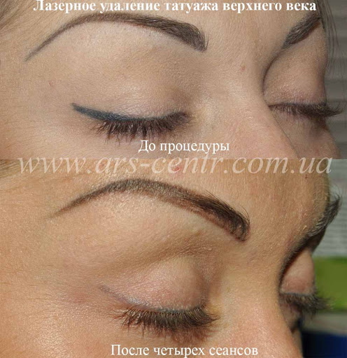 Penyingkiran laser dari solek kekal (tatu) alis, bibir, kelopak mata