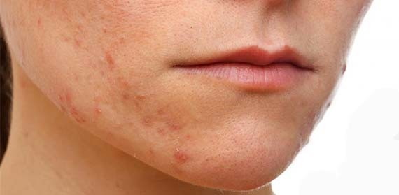 Penyingkiran laser dari solek kekal (tatu) alis, bibir, kelopak mata