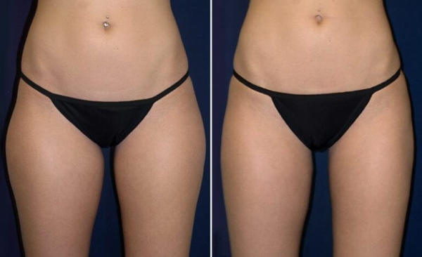 Liposuction paha dalaman. Sebelum dan selepas gambar, harga
