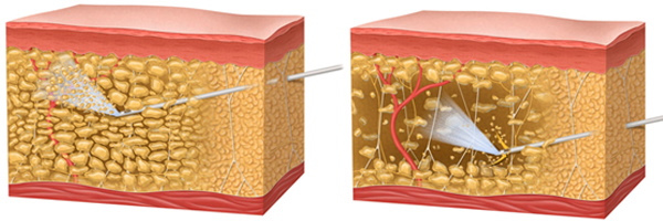 Liposuction paha dalaman. Sebelum dan selepas gambar, harga