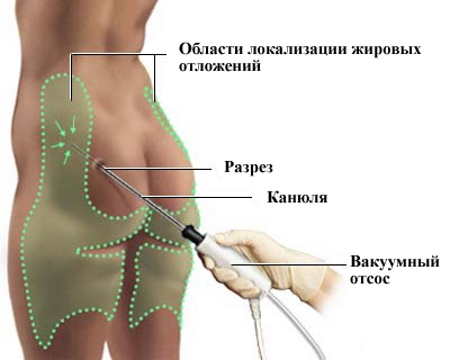 Liposuction paha dalaman. Sebelum dan selepas gambar, harga