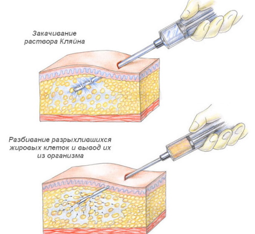 Liposuction paha dalaman. Sebelum dan selepas gambar, harga