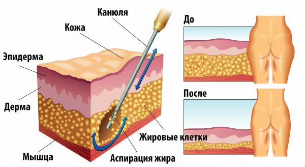 Liposuction paha dalaman. Sebelum dan selepas gambar, harga