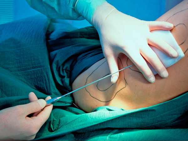 Liposuction paha dalaman. Sebelum dan selepas gambar, harga
