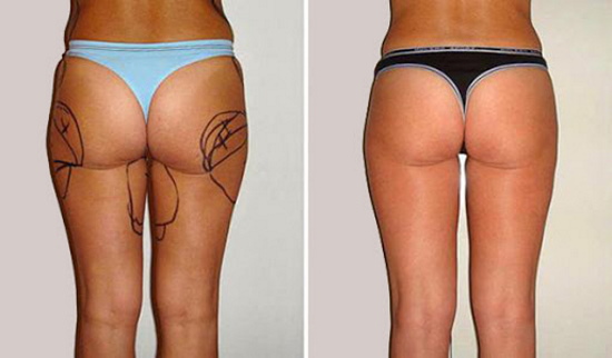 Liposuction paha dalaman. Sebelum dan selepas gambar, harga