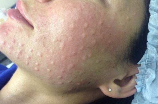 Beg di bawah mata: prosedur kosmetik, suntikan. Ulasan
