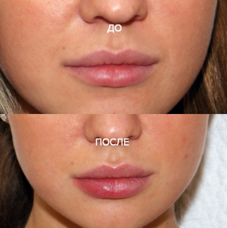 Gadis mempunyai bibir nipis. Cara meningkatkan dengan asid hyaluronik, pengisi, botox