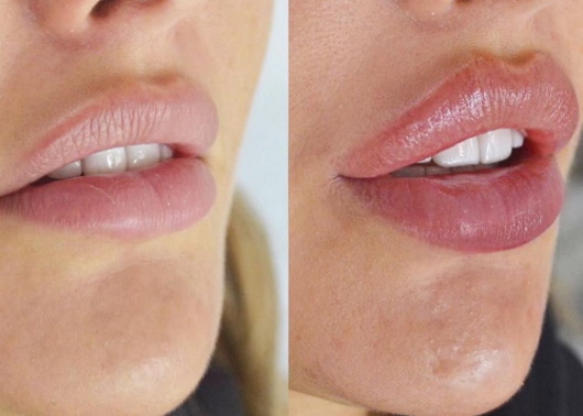 Gadis mempunyai bibir nipis. Cara meningkatkan dengan asid hyaluronik, pengisi, botox