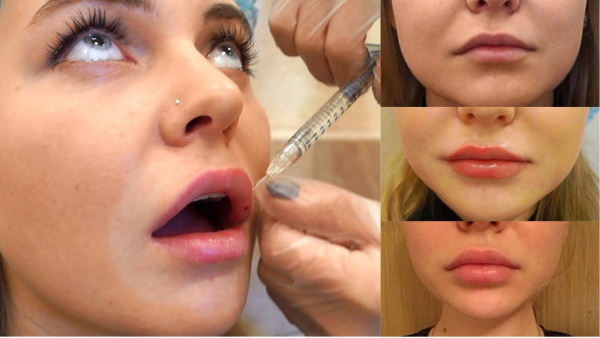 Gadis mempunyai bibir nipis. Cara meningkatkan dengan asid hyaluronik, pengisi, botox