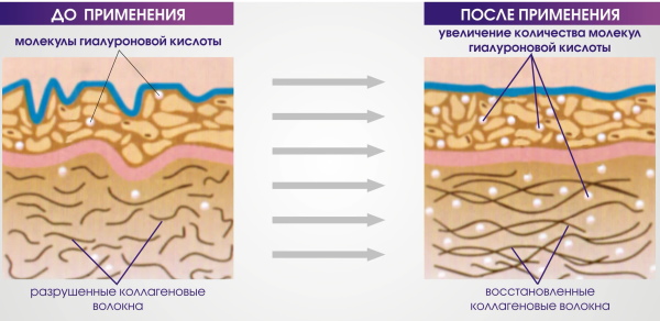 Gadis mempunyai bibir nipis. Cara meningkatkan dengan asid hyaluronik, pengisi, botox